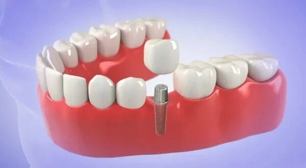 How to Fix Sensitive Teeth – Tips, Ideas, and Home Remedies