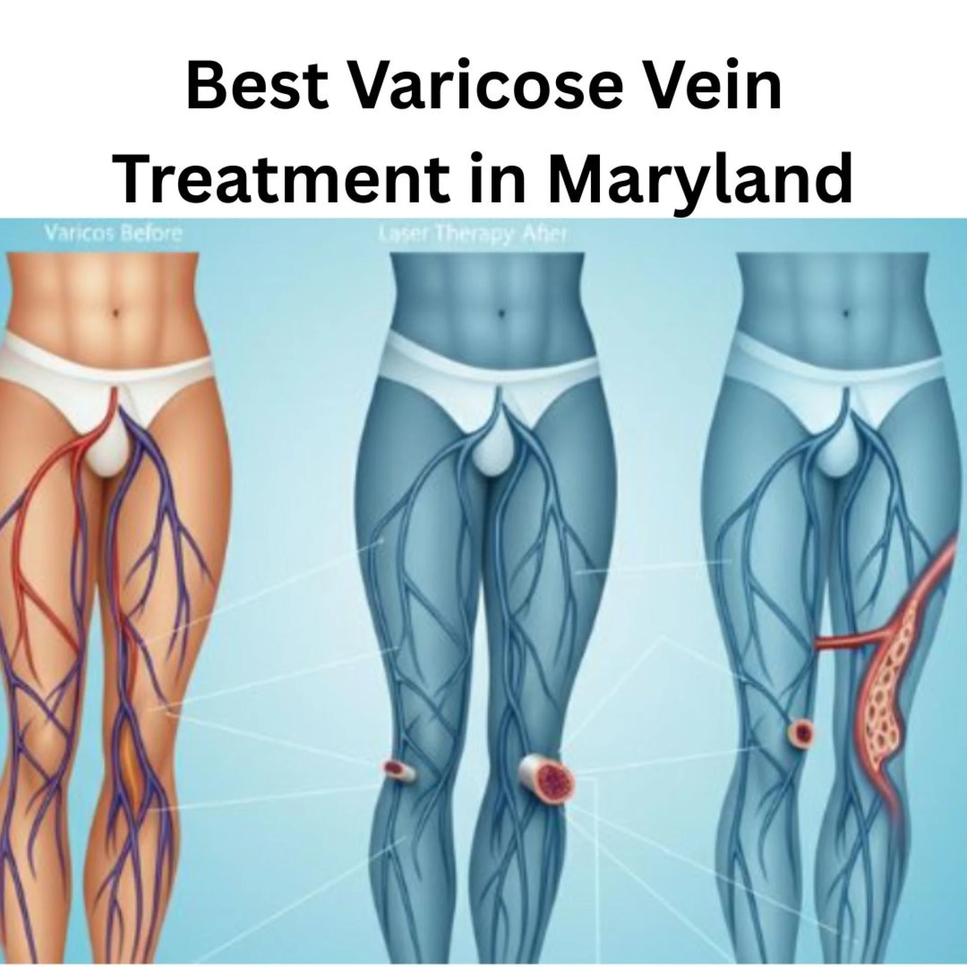 Laser vs. Sclerotherapy: Best Varicose Vein Treatment in Maryland?