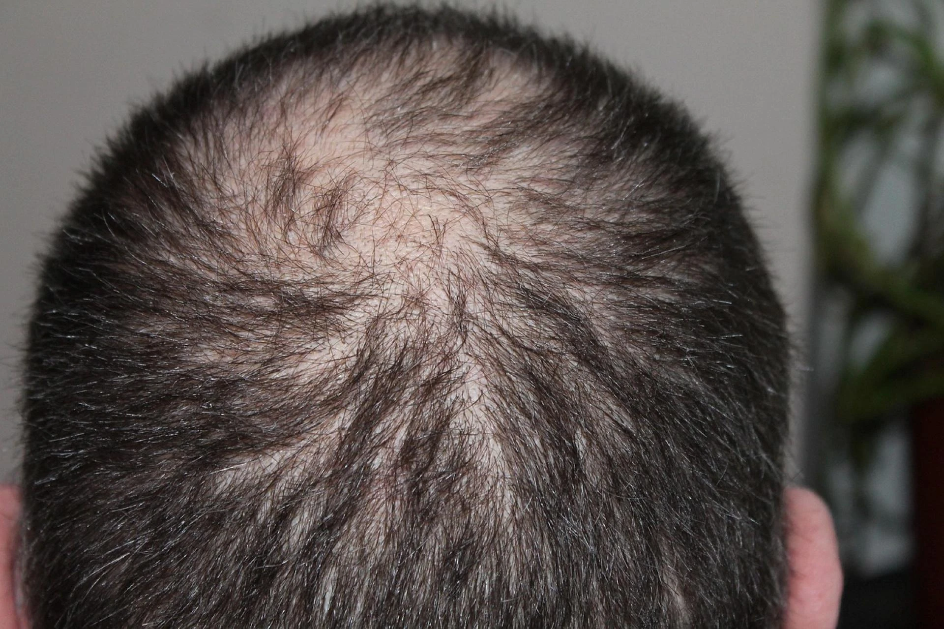 Hair Loss After 30: Advanced Options You Should Know About