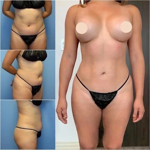 How to Enhance Your Body Shape with Body Contouring Surgery in Dubai