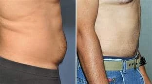 LIPOSUCTION