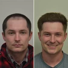 How Much Does a Beard Transplant Cost in Los Angeles?