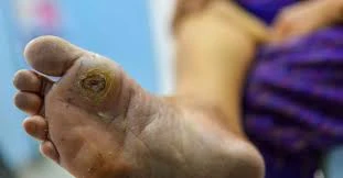 Top Foot Doctor in Houston TX for Surgery, Wounds & Wart Care