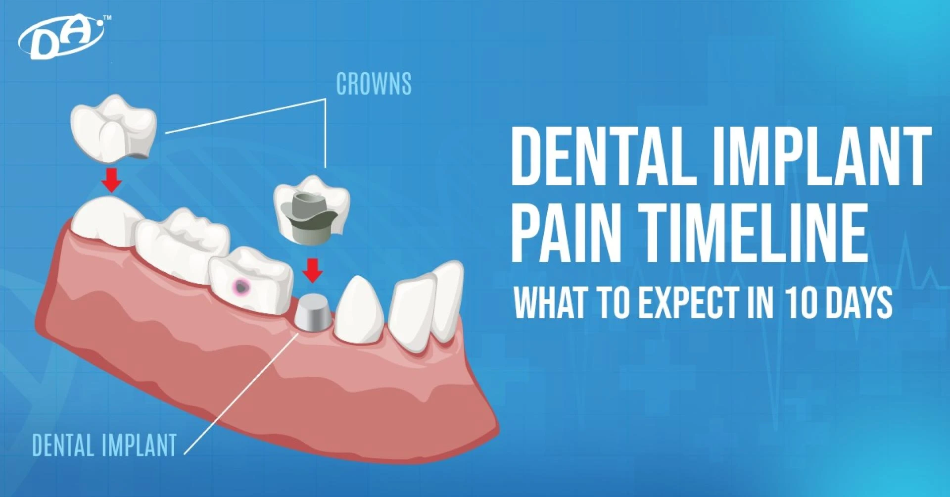 Dental Implant Pain Timeline: What to Expect in 10 Days