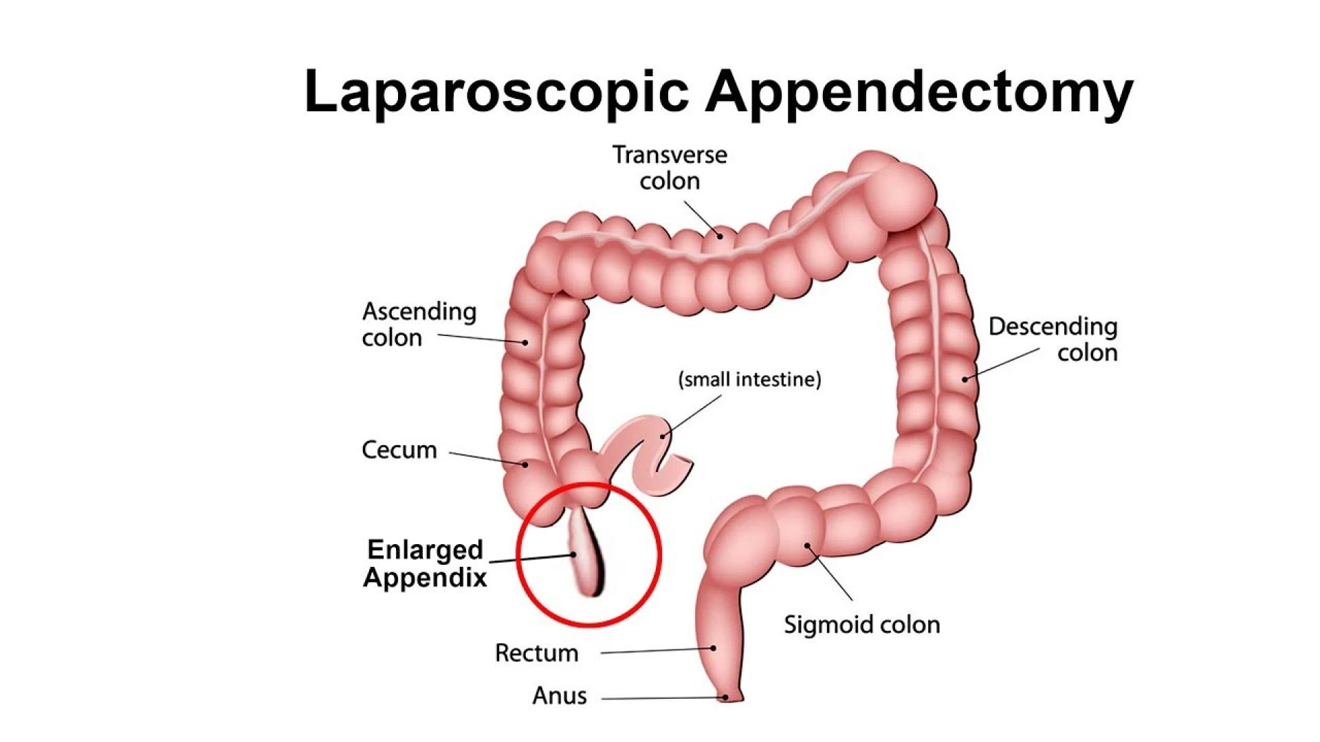 Top 5 Medical Facts About Laparoscopic Appendectomy You Didn’t Know