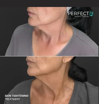 Non-Surgical Skin Tightening Treatments in Doral, FL: Restore Your Youthful Look Naturally
