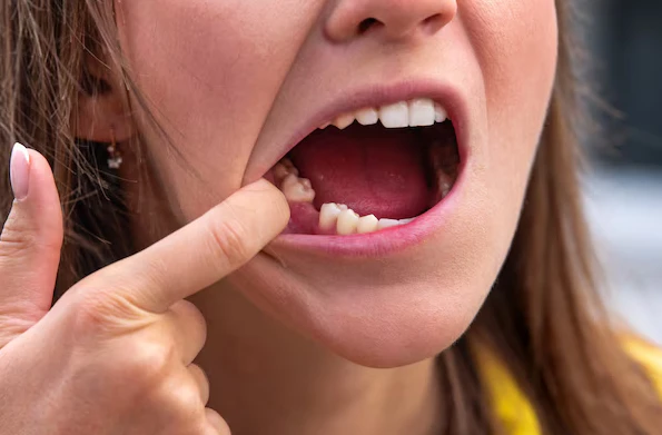 Dental Implants - Restore Your Smile and Prevent Oral Health Issues