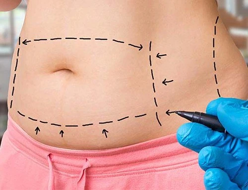 Tummy Tuck: Restoring a Firm, Confident Midsection