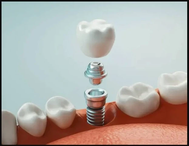 Dental Implants: Restoring Your Smile and Confidence