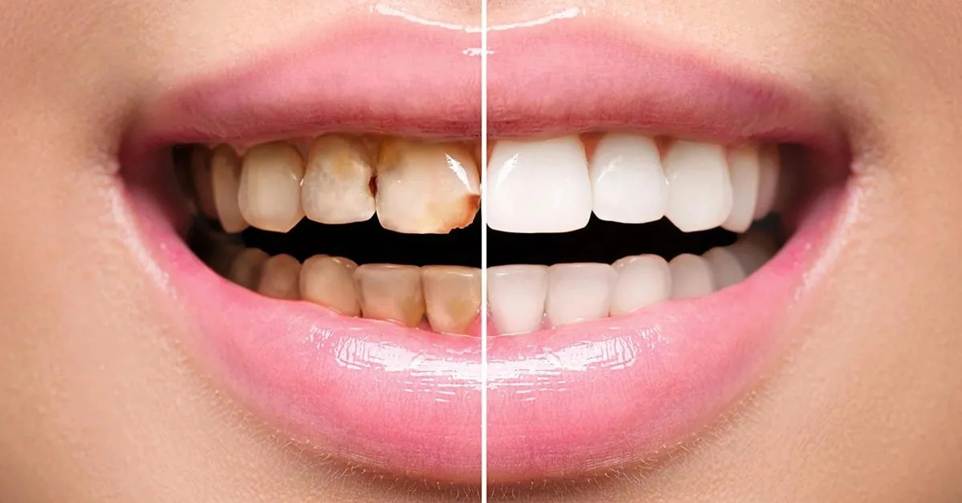 Dental Veneers in Islamabad