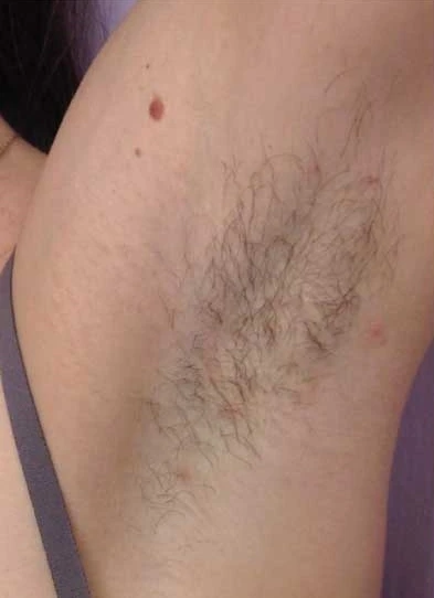 Laser Hair Removal: Debunking The Most Popular Myths About It