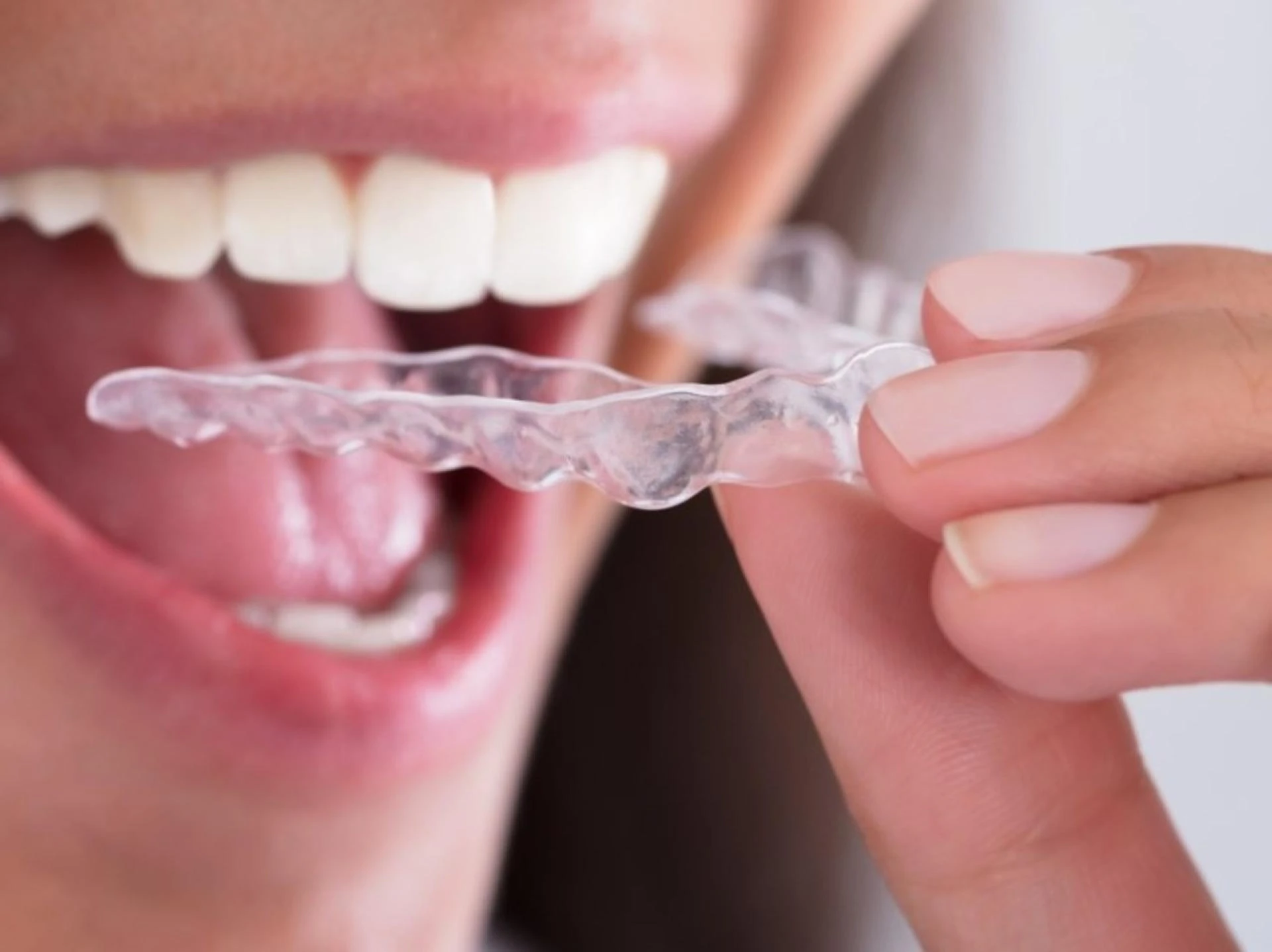 Need an Invisalign Treatment in Cardiff? Clear Out These Myths First!