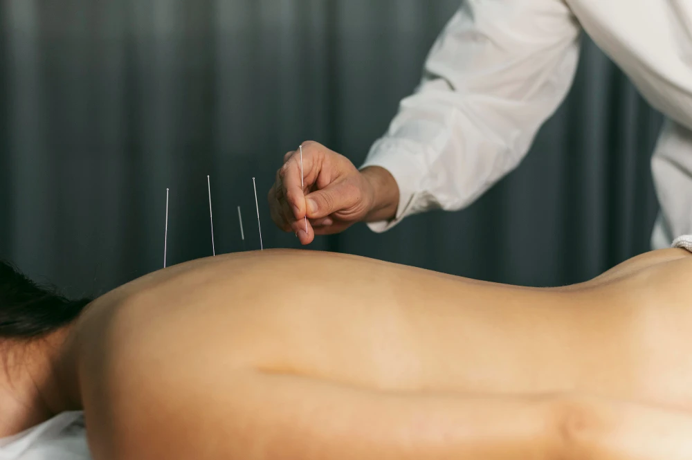 Find Trusted Acupuncture Near Me for Pain Relief and Wellness Today