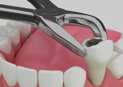 Tooth Extraction Tampa: Gentle and Professional Care with Harmony Dental and Facial Aesthetics