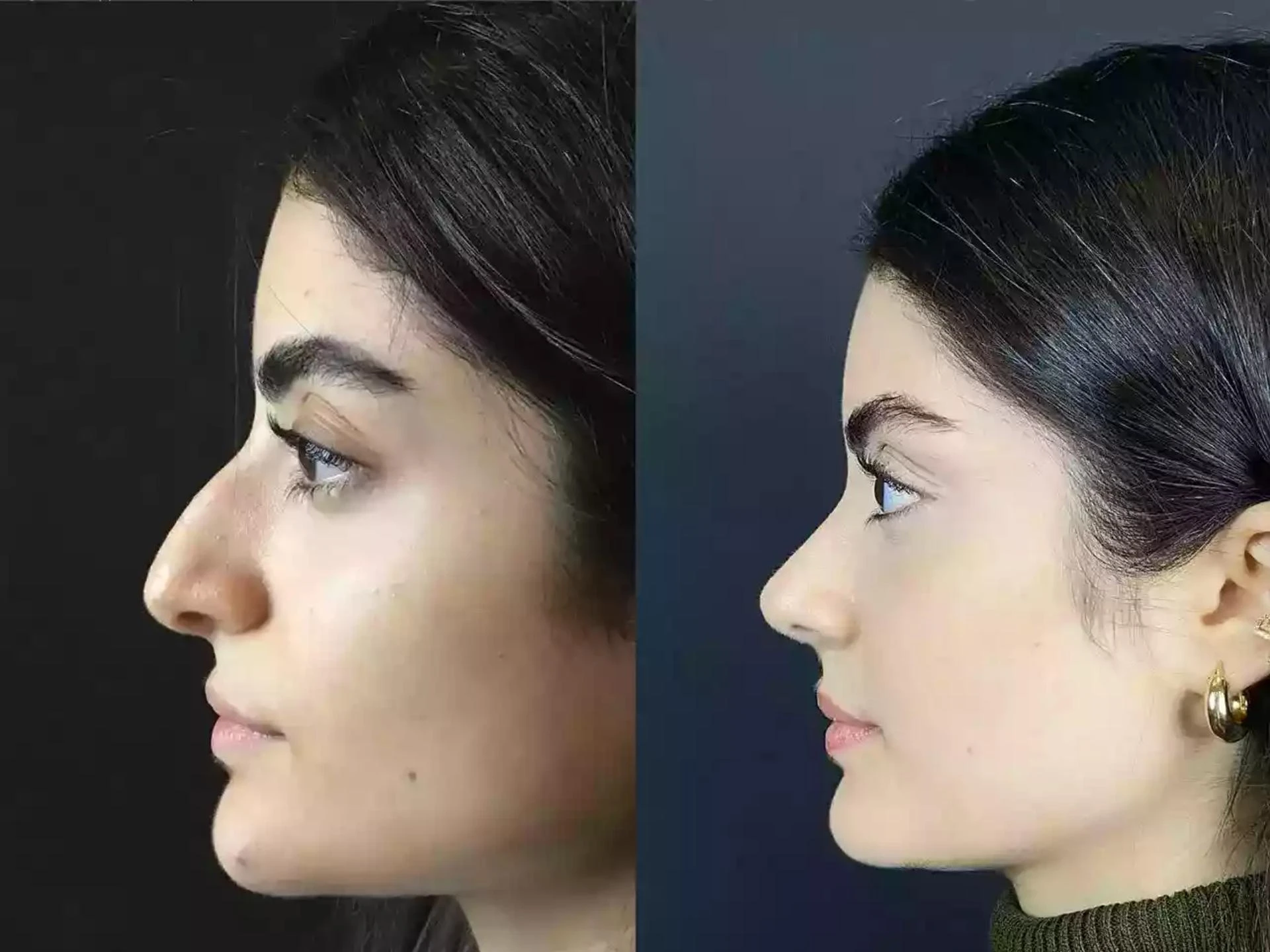 Can Rhinoplasty in Dubai Fix a Broken Nose?