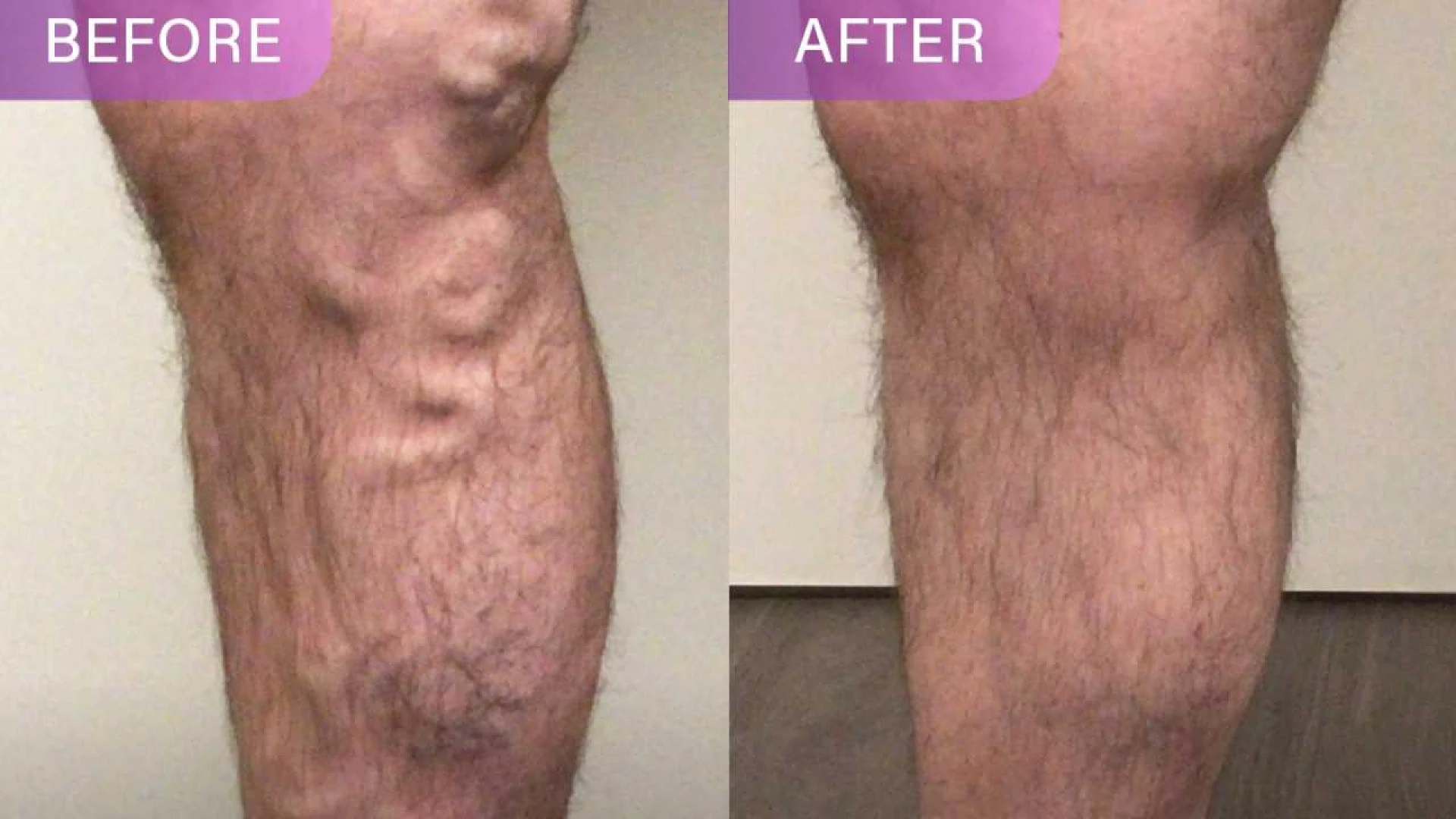 How Do Vein Specialists In New York Diagnose Vein Problems?