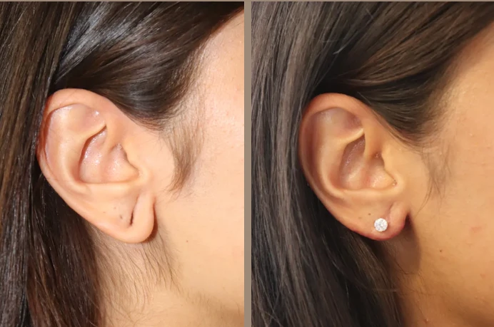Earlobe Surgery: Everything You Need to Know About Repairing and Enhancing Your Earlobes