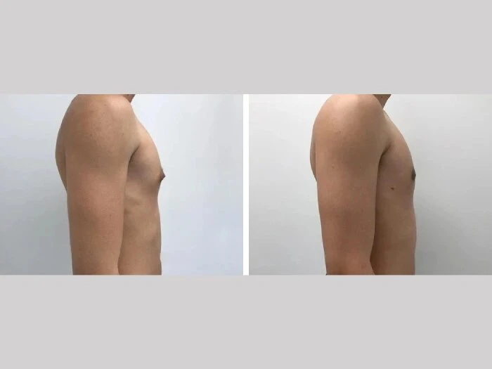 Real Patients, Real Results: Best Gynecomastia Surgeon in dubai
