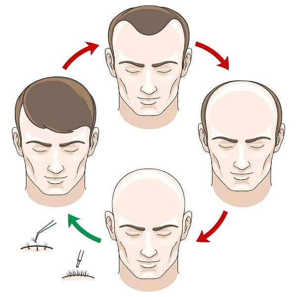 Who Is the Ideal Candidate for an FUE Hair Transplant in Manchester?
