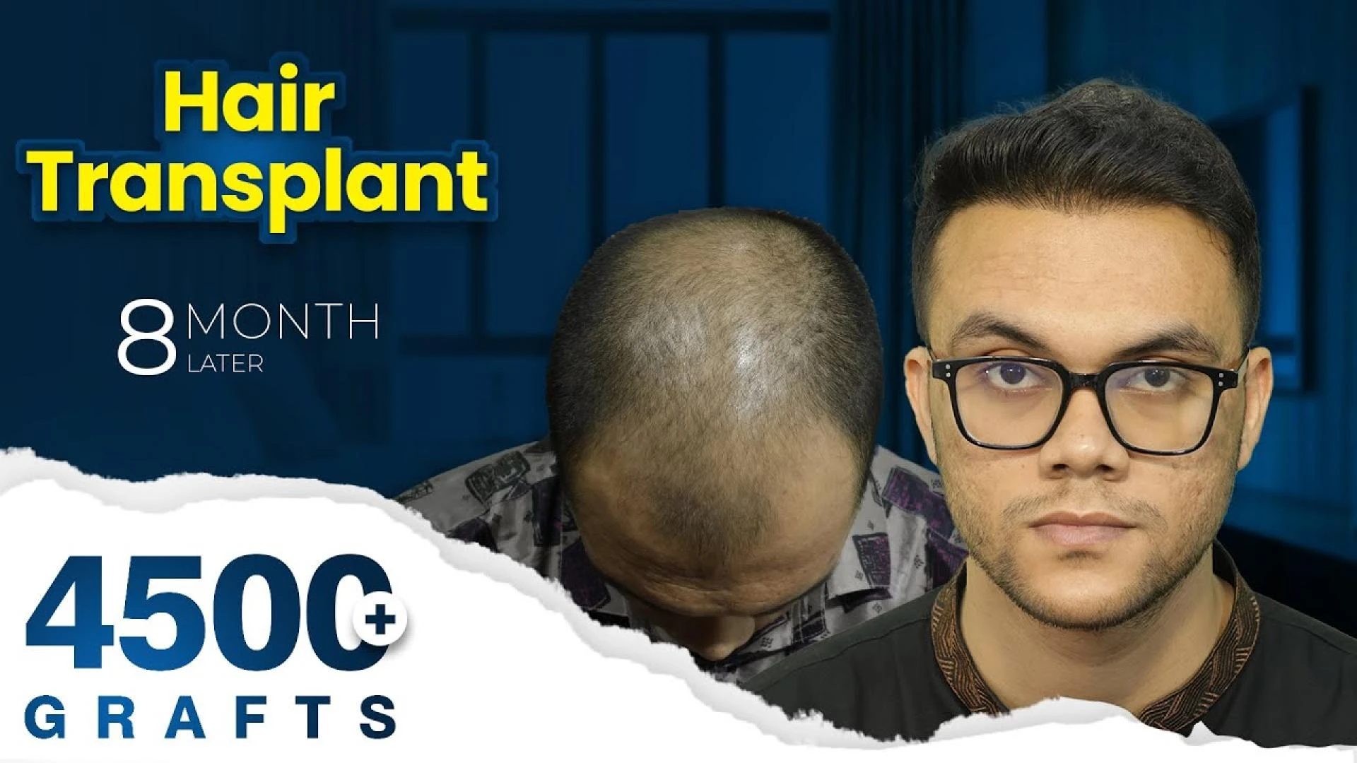Hair Transplant in Dhaka – Cost, Recovery & Best Options