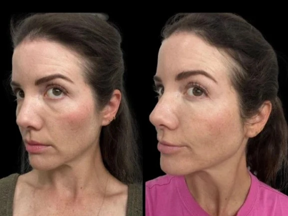 Customized Dark Circles Treatment Plans at the Best Aesthetic Clinics in Dubai