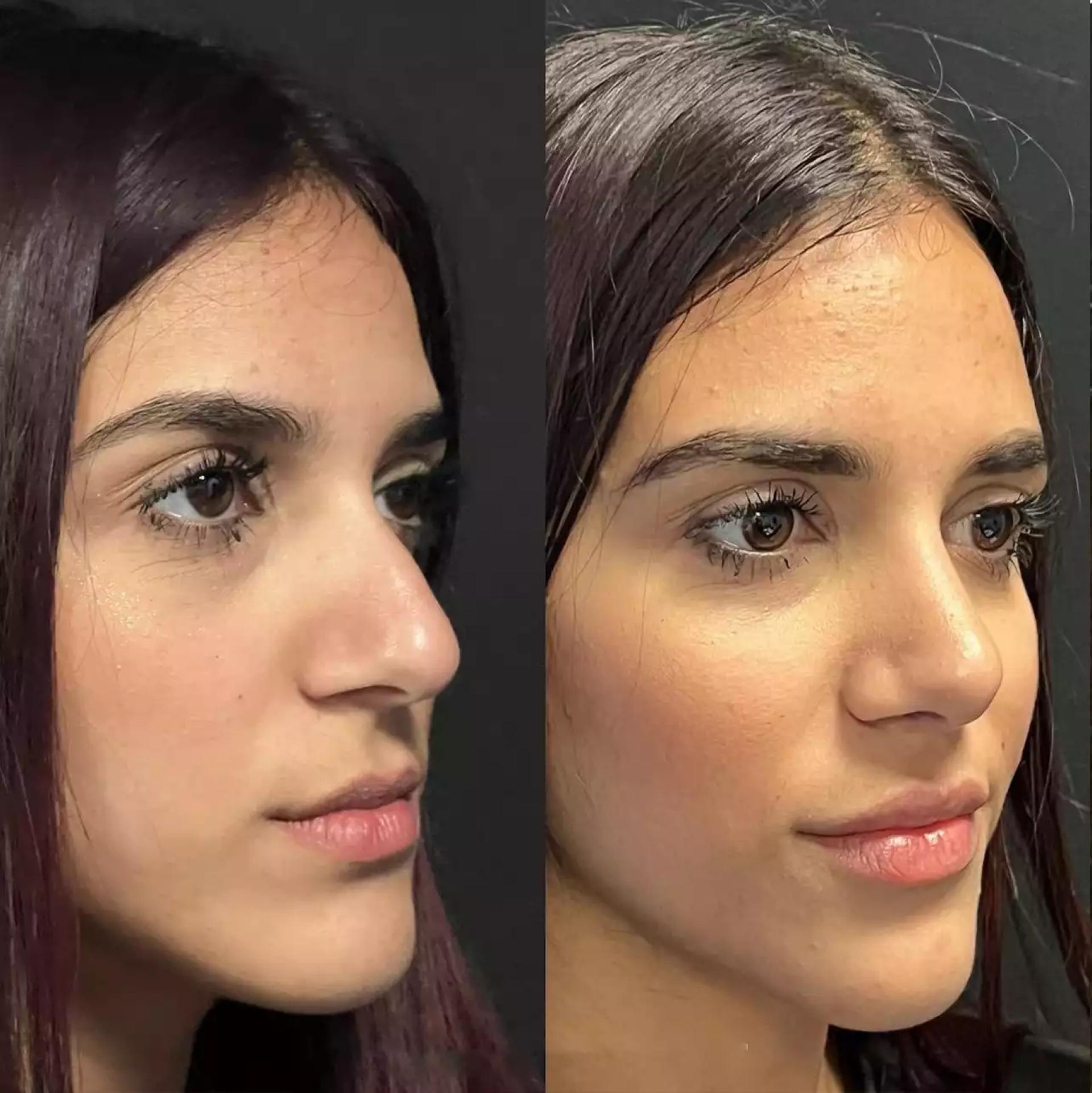 Best Rhinoplasty Surgeons in Dubai for Perfect Nose Profiles