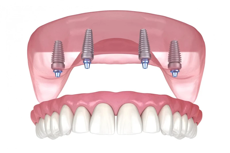 Top 5 Myths About Dental Implants