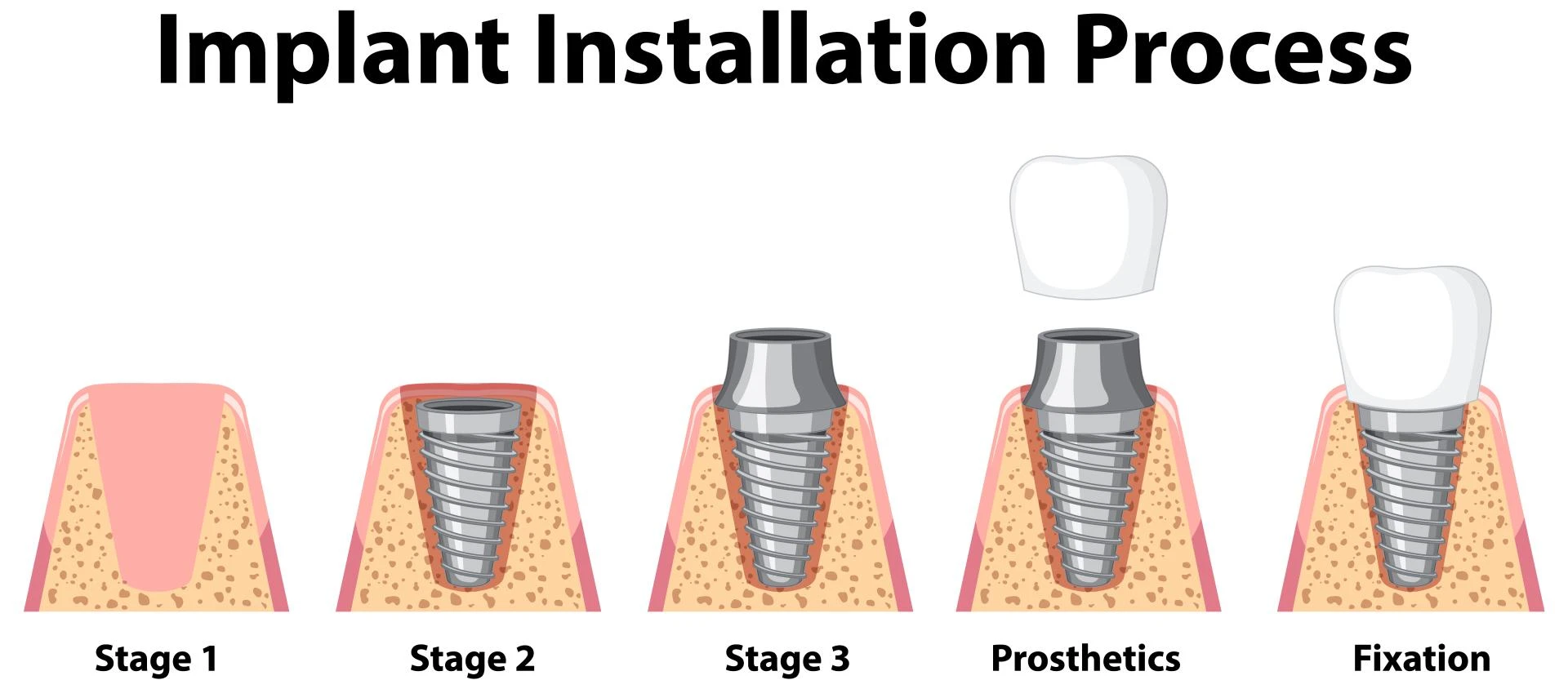 Everything You Need to Know About the Dental Implant Process 