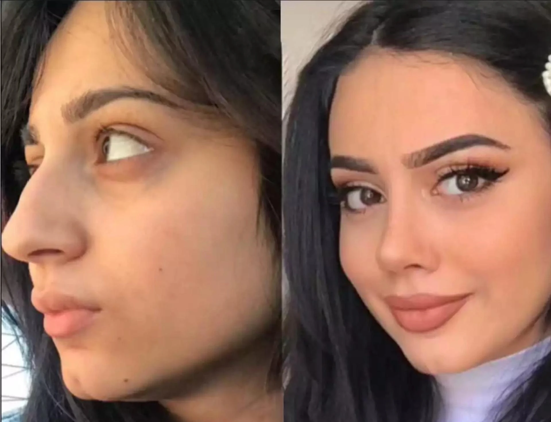 Rhinoplasty in Dubai: Can It Be Combined with Septoplasty?