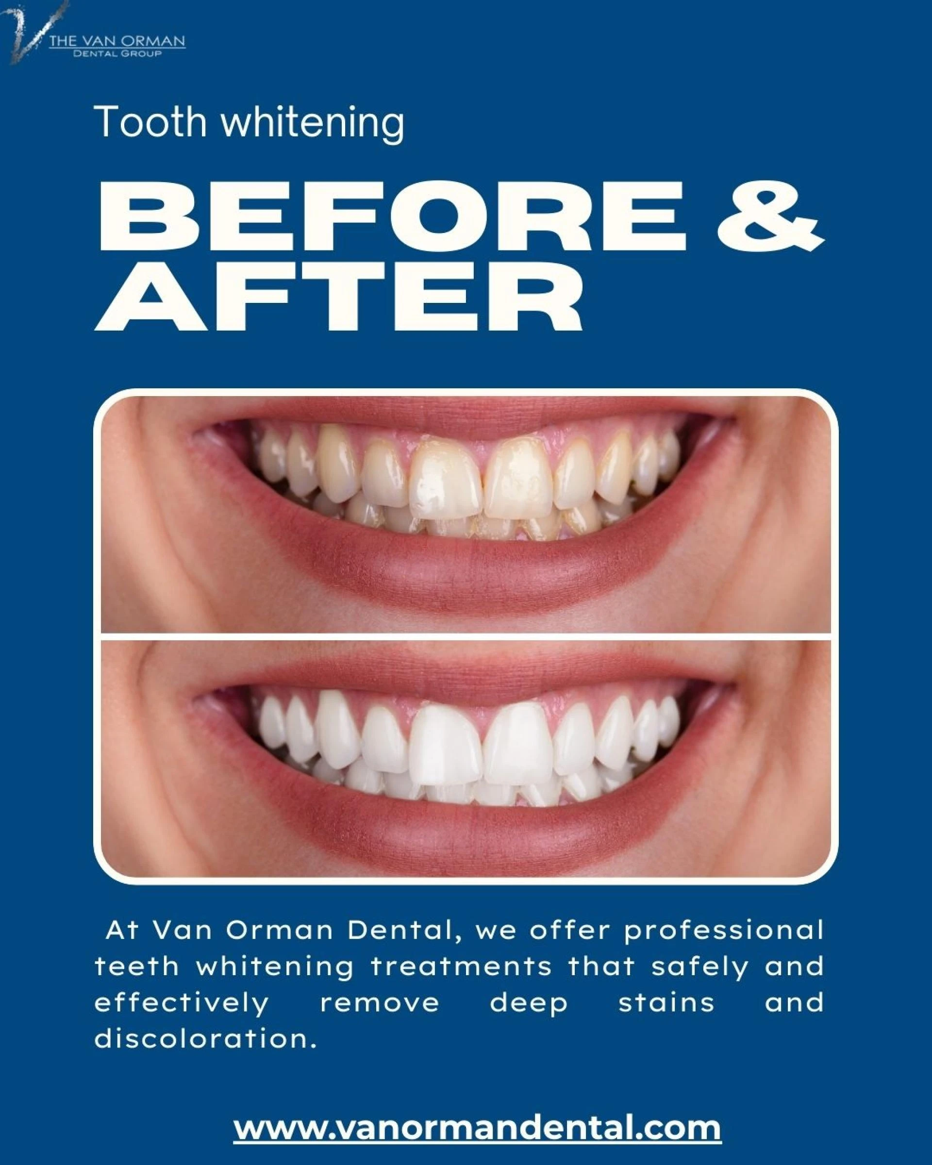 Is Teeth Whitening the Right Choice for You?