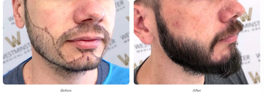Beard Transplant London: Restore Your Confidence with Westminster Medical Group