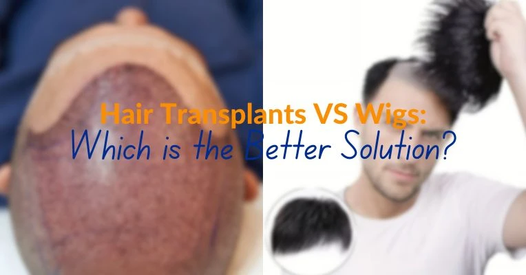Hair Transplant vs Hair Wigs: Which One Is Right for You?