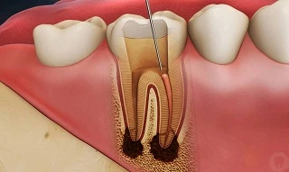 Root Canal Decisions: Dentists’ Criteria for Pulp Therapy
