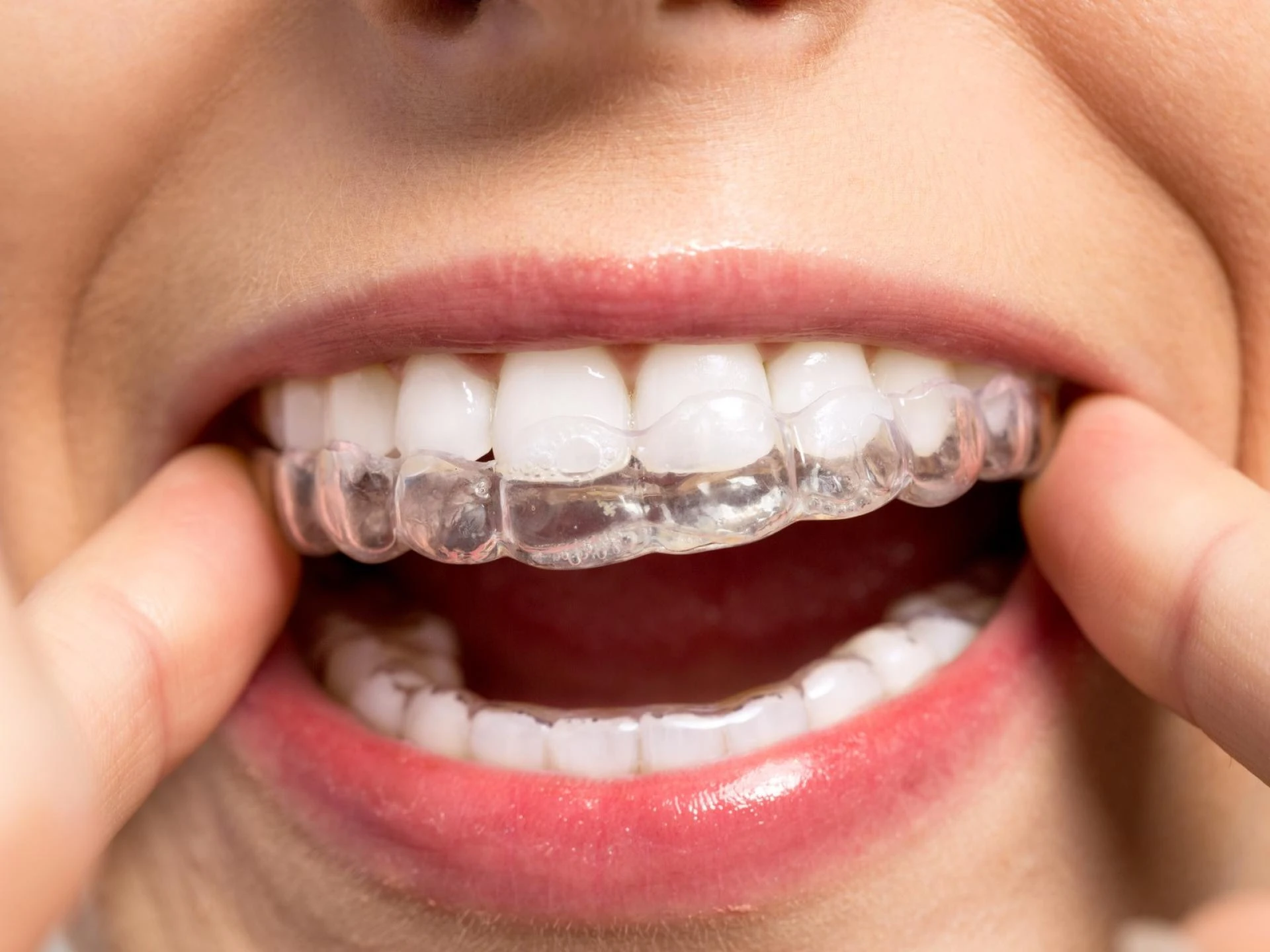 Retainers After Aligners: How to Keep Teeth Straight