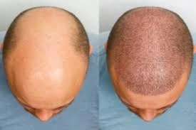 Hair Transplant in India – Best Solutions, Cost, and Advantages
