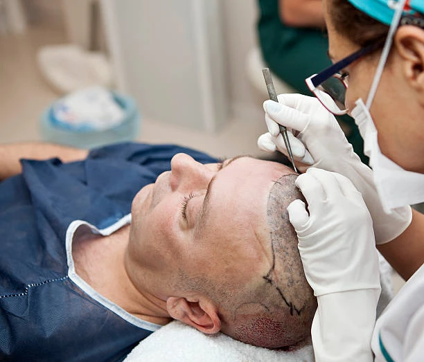 What to Know About Hair Transplant and Scalp Health