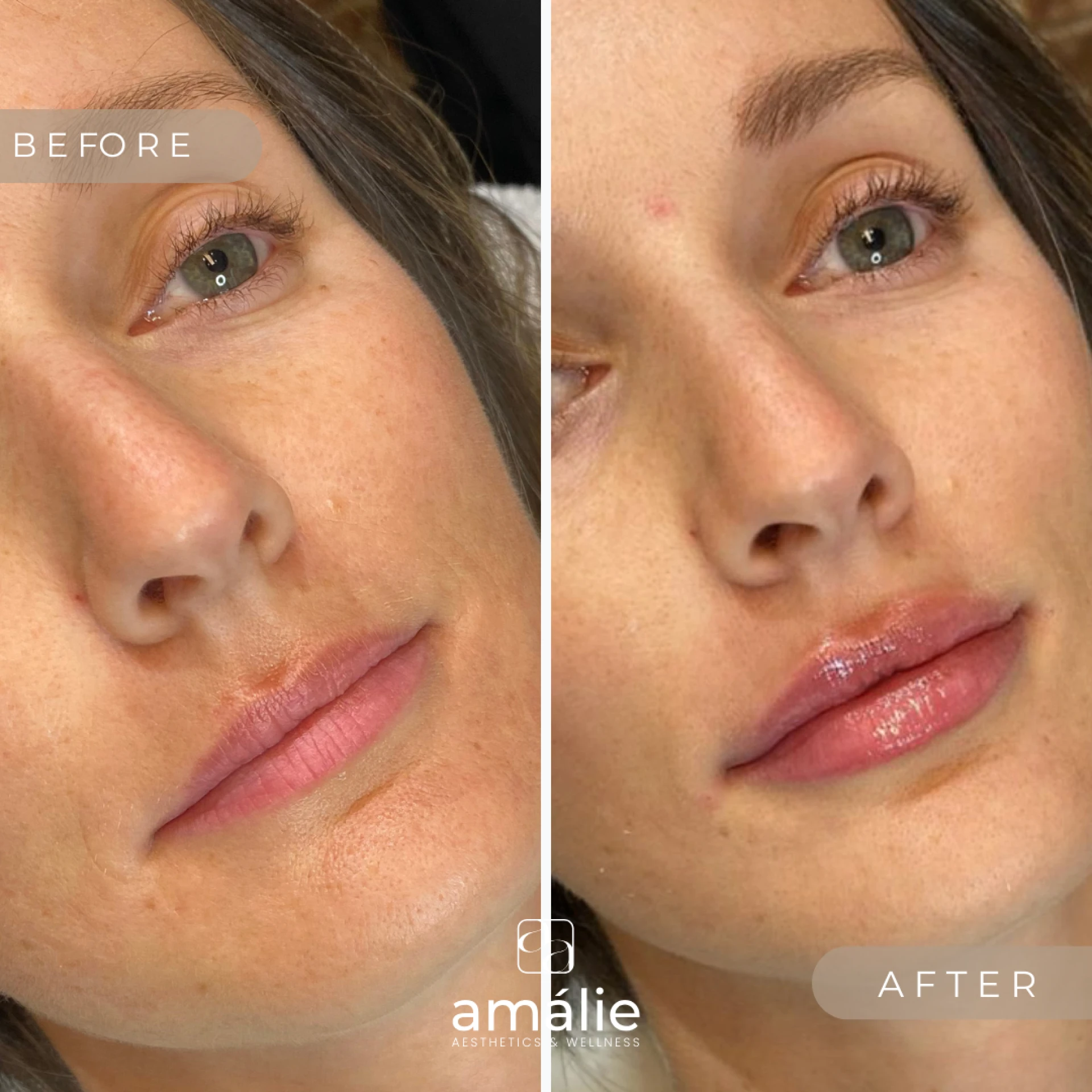 Boost Your Confidence with Minimally Invasive Lip Fillers & Aesthetic Treatments