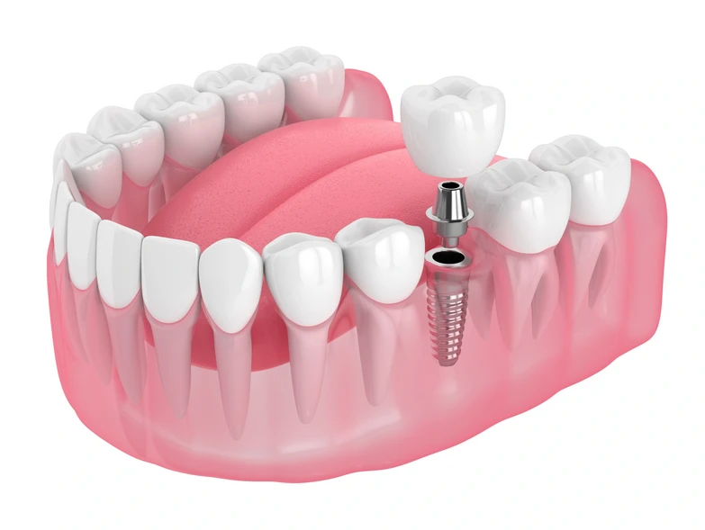 What to Expect When Visiting a Dental Implants Clinic