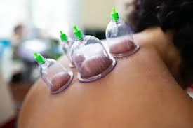 Traditional Cupping Therapy: An Ancient Healing Art