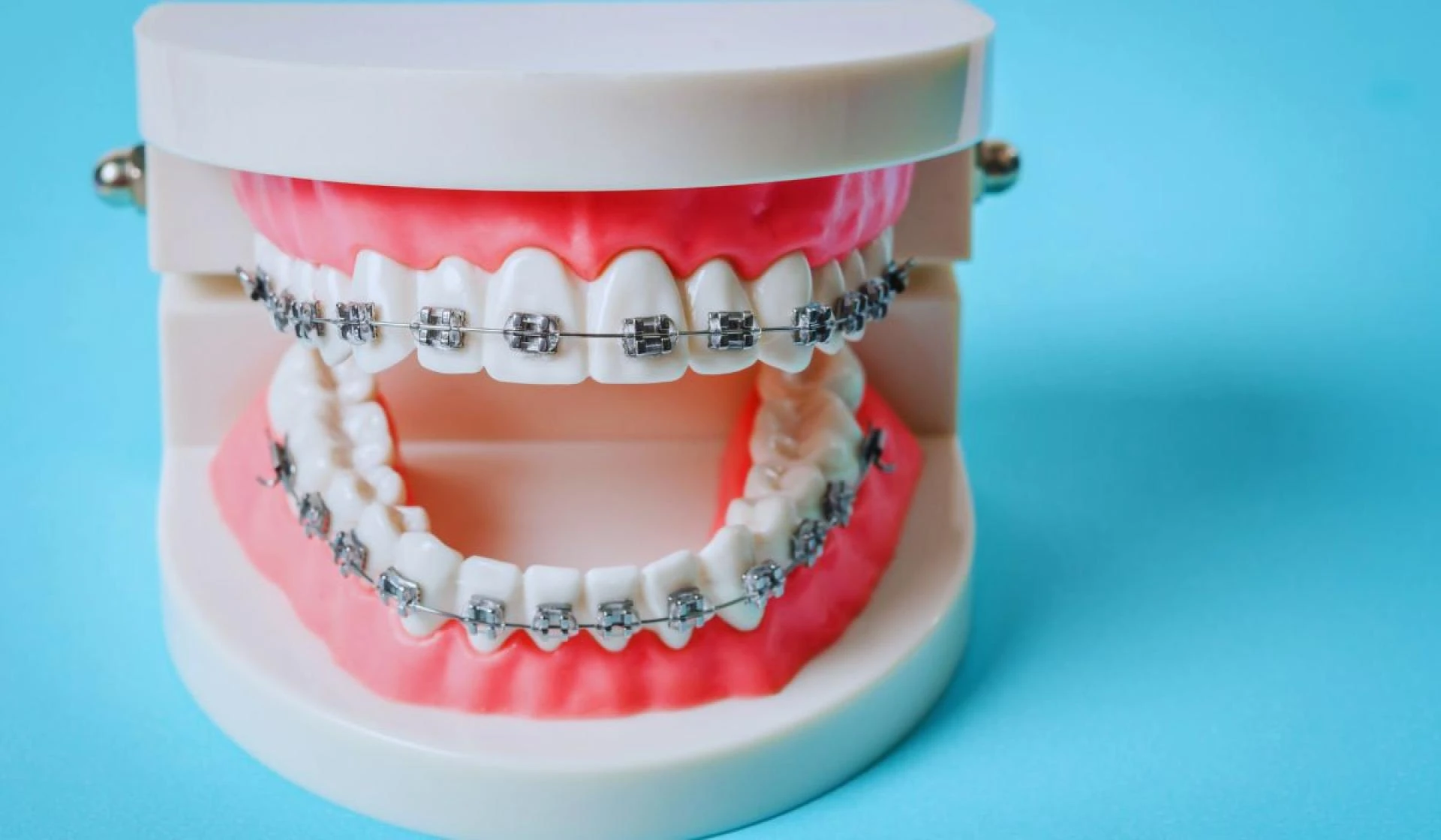 Dental Implant in Lahore – A Permanent Solution for Missing Teeth