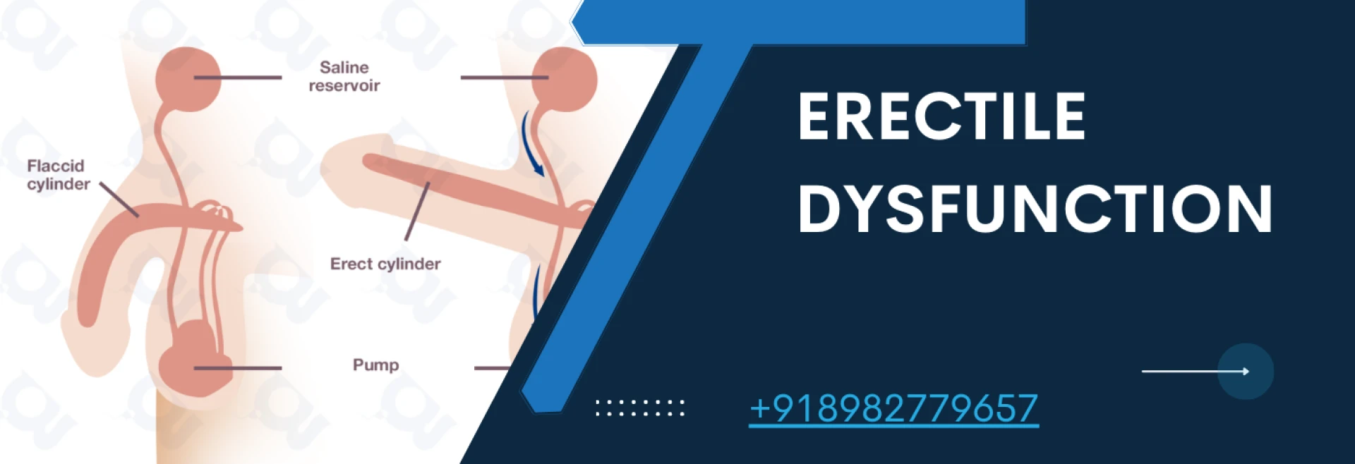 The Greatest Homeopathic Treatment for Erectile Dysfunction: An All-Natural Way to Gain Self-Assurance Again