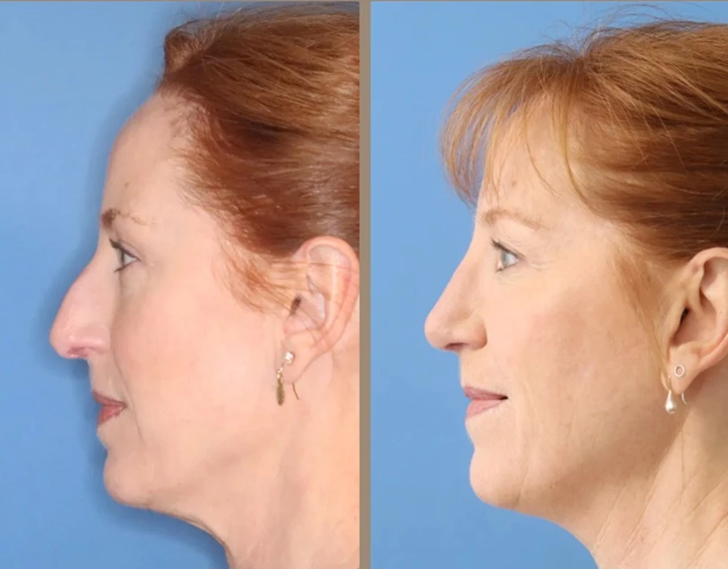 Rhinoplasty Surgery: A Complete Guide to Achieving Your Ideal Nose