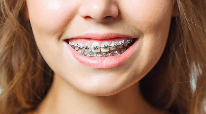 Top 5 Benefits of Braces Treatment You Might Not Know