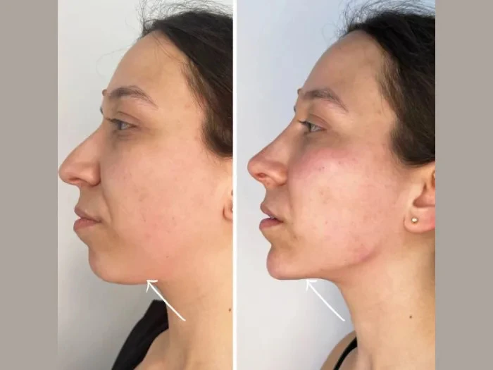 Sculpt and Refresh with Endolift from the Best Doctors in Dubai