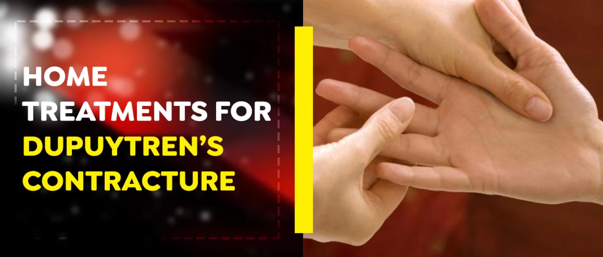 5 Best Natural Dupuytren's Disease Treatment