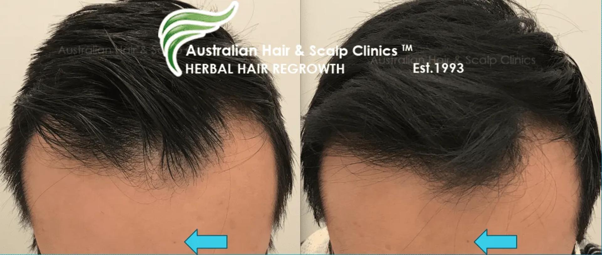 Discover Organic Care for Alopecia in Melbourne