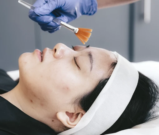 Chemical Peels Toronto: Rejuvenate Your Skin with Sovereign Skin