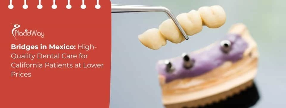 Dental Bridges in Mexico: High-Quality Dental Care for California Patients at Lower Prices