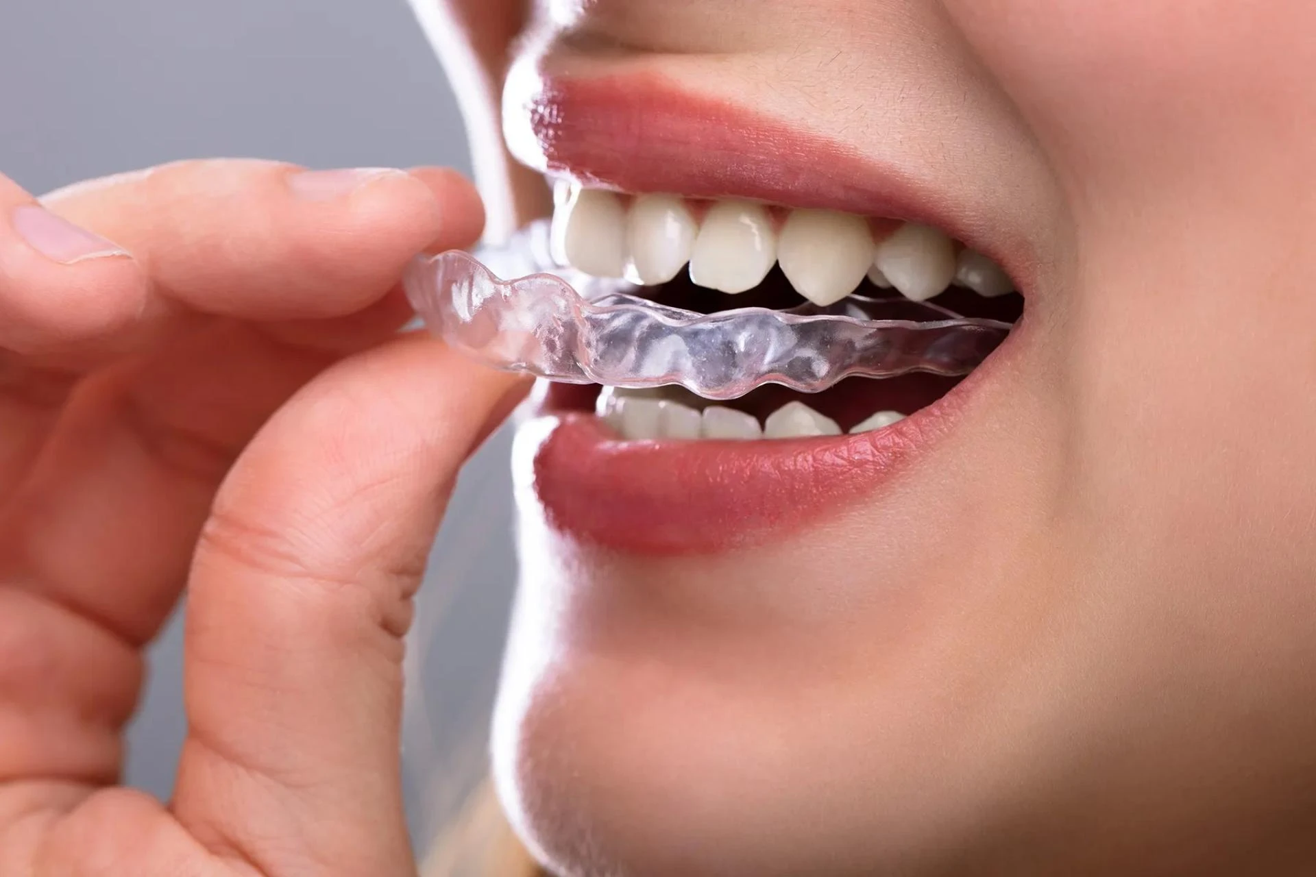 Clear Aligners: Practical Benefits Explained