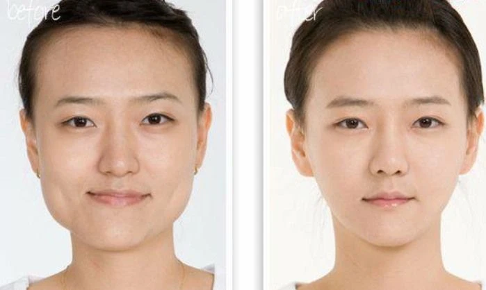 Jawline Botox: Amazing Before and After Results
